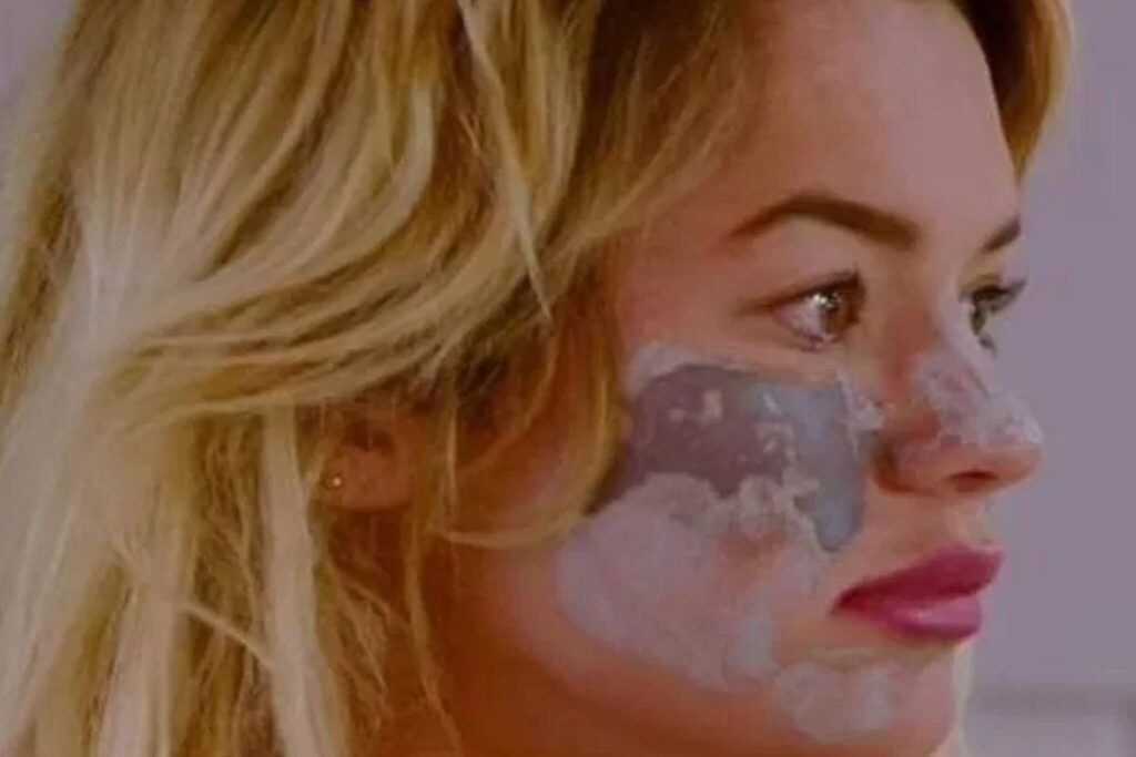  కానీ అది ఆమెకు రియాక్షన్ ఇచ్చింది. ముఖం మాడిపోయింది. కాలిపోయింది. మచ్చలు వచ్చేశాయి. కురుపులు వచ్చేశాయి. మొత్తం తేడా కొట్టింది. అందమైన ఫేస్ కాస్తా... ఇలా అయిపోయింది. (image Credit - Instagram - tillywhitfeld)