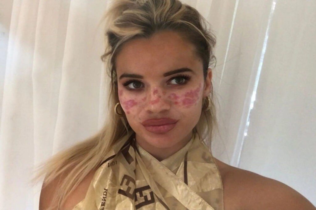  ఈ బ్యూటీ కంటిన్యూగా టీవీ షోలు ఇతరత్రా ఫ్యాషన్ ప్రోగ్రామ్స్ చేస్తూ... నిరంతరం ఫేసుకి మేకప్ వేసుకుంటూనే ఉంది. 2 నెలల కిందట టిక్ టాక్‌లో ఓ అక్యుపంక్చర్ బ్యూటీ టిప్ వీడియో చూసింది. అది నచ్చడంతో... సేమ్ అలాగే ఇంట్లో అప్లై చేసుకుంది. (image Credit - Instagram - tillywhitfeld)