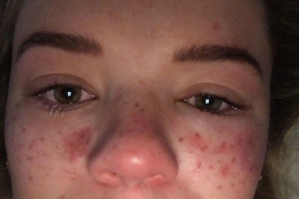  ఈ ఘటన తర్వాత ఆమె ఆస్పత్రి పాలైంది. తన ఫేసును తానే గుర్తు పట్టలేని విధంగా అయిపోవడం చూసి షాకైంది. (image Credit - Instagram - tillywhitfeld)