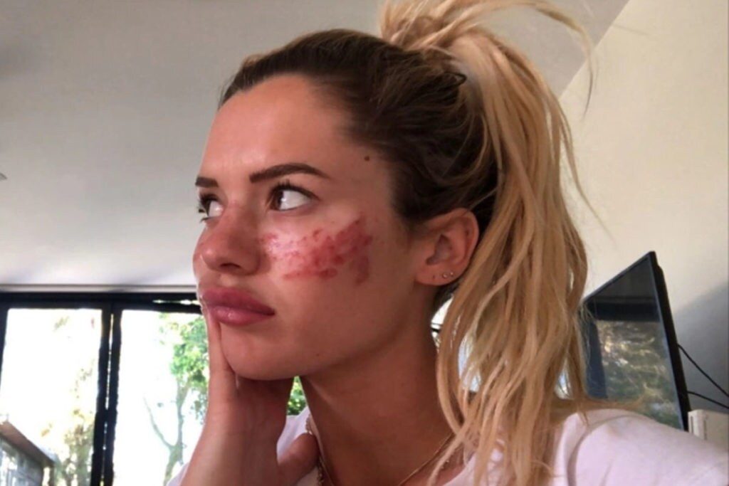  ఆ బ్యూటీ టిప్ కారణంగా... ఆమెకు ఎడమ కన్ను తాత్కాలికంగా కనిపించట్లేదు. ముఖంపై వచ్చిన ఎర్రటి మచ్చలు చాలా కాలం ఉంటాయట. (image Credit - Instagram - tillywhitfeld)