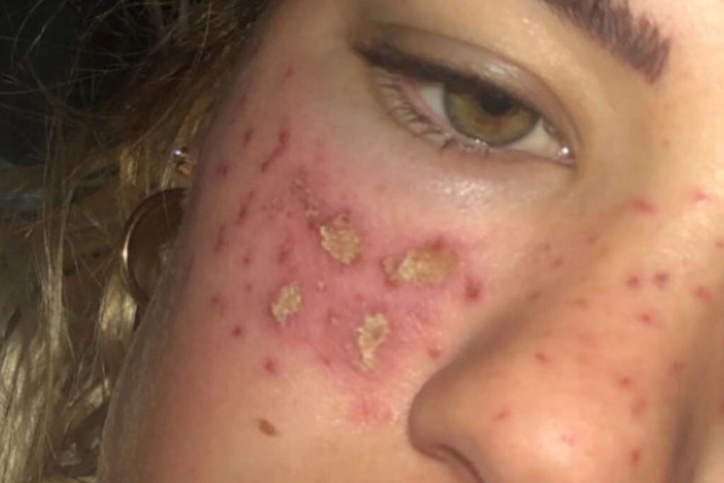  దయచేసి నాలాగా ఎవరూ ఇలాంటి హోమ్ హ్యాక్స్ (home hacks) చేయకండి. సోషల్ మీడియాలో వచ్చే వీడియోలు చూసి మోసపోకండి. ఏం చేసుకోవాలన్నా ప్రొఫెషనల్స్ ద్వారానే చేసుకోండి అని సూచించింది టిల్లీ. (image Credit - Instagram - tillywhitfeld)