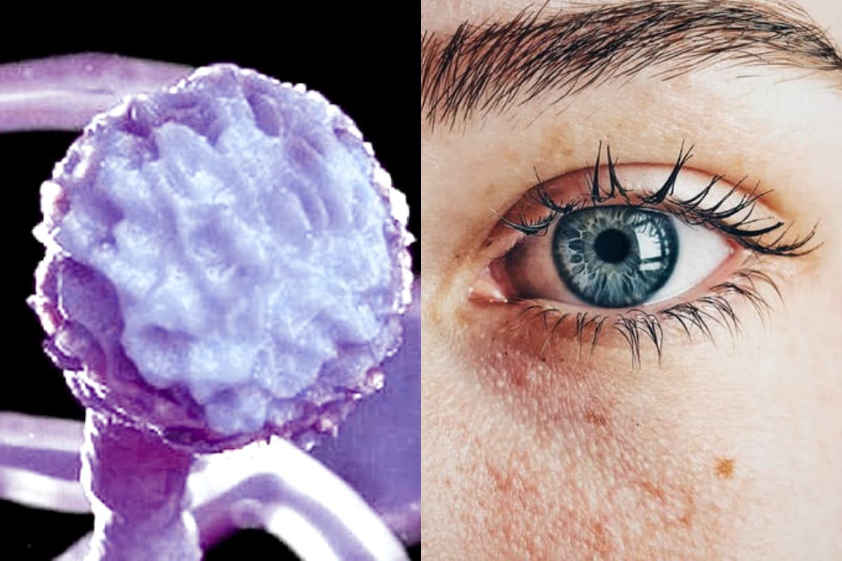 Black Fungus బ్లాక్ ఫంగస్ నుంచి కళ్లను కాపాడుకోండి... ఇవి ఎక్కువగా