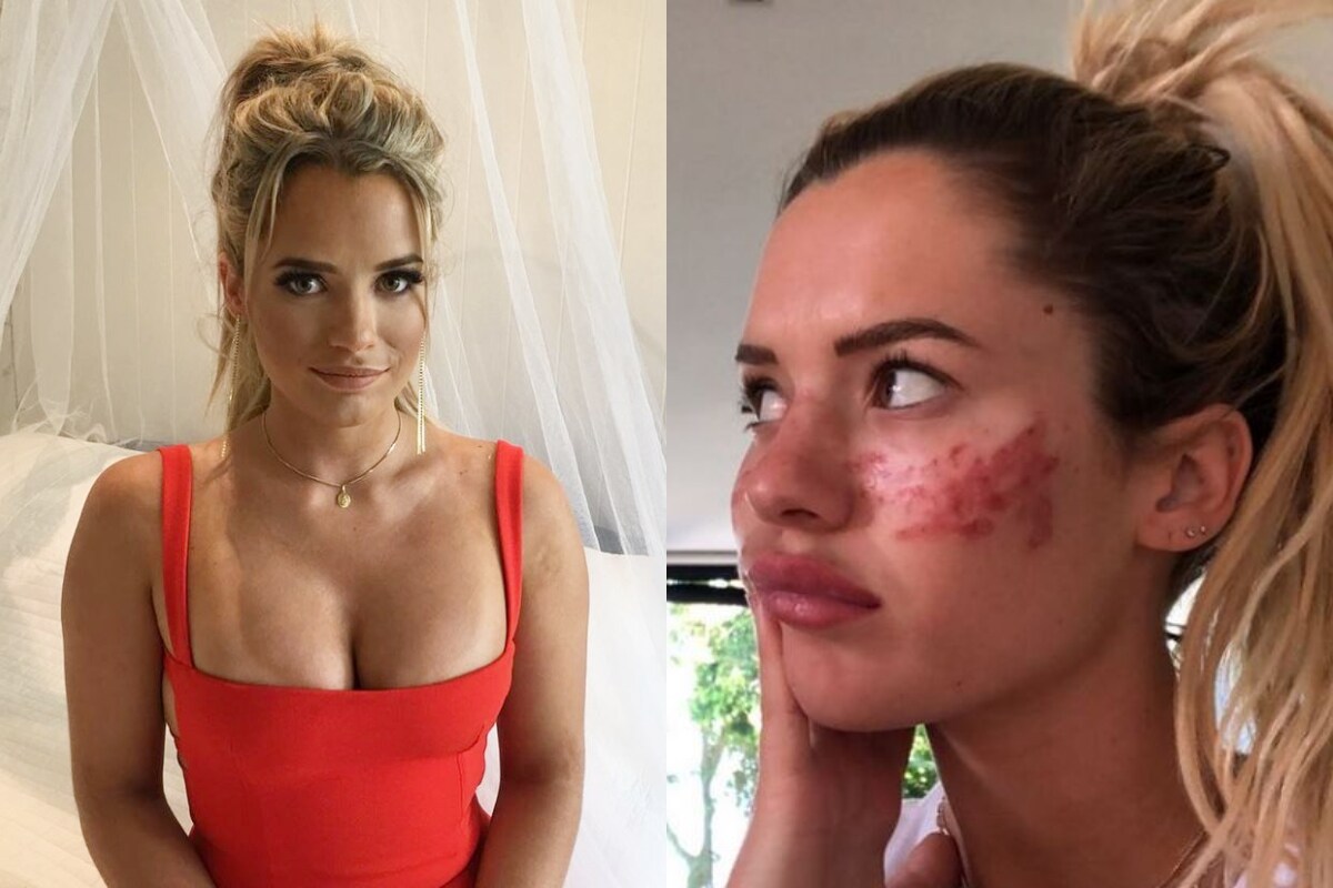  Beauty Tips: టిక్ టాక్ బ్యూటీ, ఆస్ట్రేలియా బిగ్ బ్రదర్ కంటెస్టెంట్... 21 ఏళ్ల టిల్లీ విట్‌ఫెల్డ్... తన విషాద కథను నెటిజన్లతో పంచుకుంది. ఓ వీడియో చూసి... అప్లై చేసుకున్న బ్యూటీ టిప్... ఆమెను గుర్తుపట్టలేని విధంగా మార్చేసింది. చివరకు ఆస్పత్రిపాలైంది తనలా ఎవరూ ఇలాంటి తప్పు చేయవద్దని కోరుతూ... తన కథను నెటిజన్లతో పంచుకుంది. (image Credit - Instagram - tillywhitfeld)