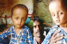 Rare Disease: ఆ పిల్లాడి తల పెరుగుతోంది.. అంతు చిక్క‌ని వ్యాధితో బాధప‌డుతున్న ఆరేళ్ల బాబు