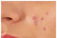 Pimples Treatment: మొటిమలను త్వరగా వదిలించుకోవడానికి 6 మార్గాలు.. వీటితో ప్రయోజనం పక్కా..