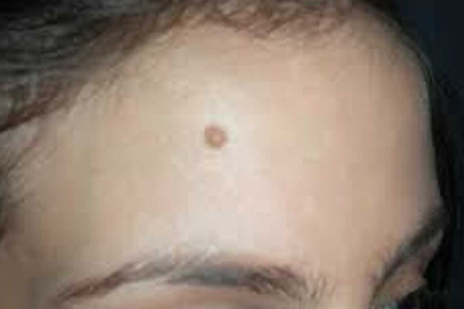 Mole : పెదవి, చెవి, ముక్కుపై ...