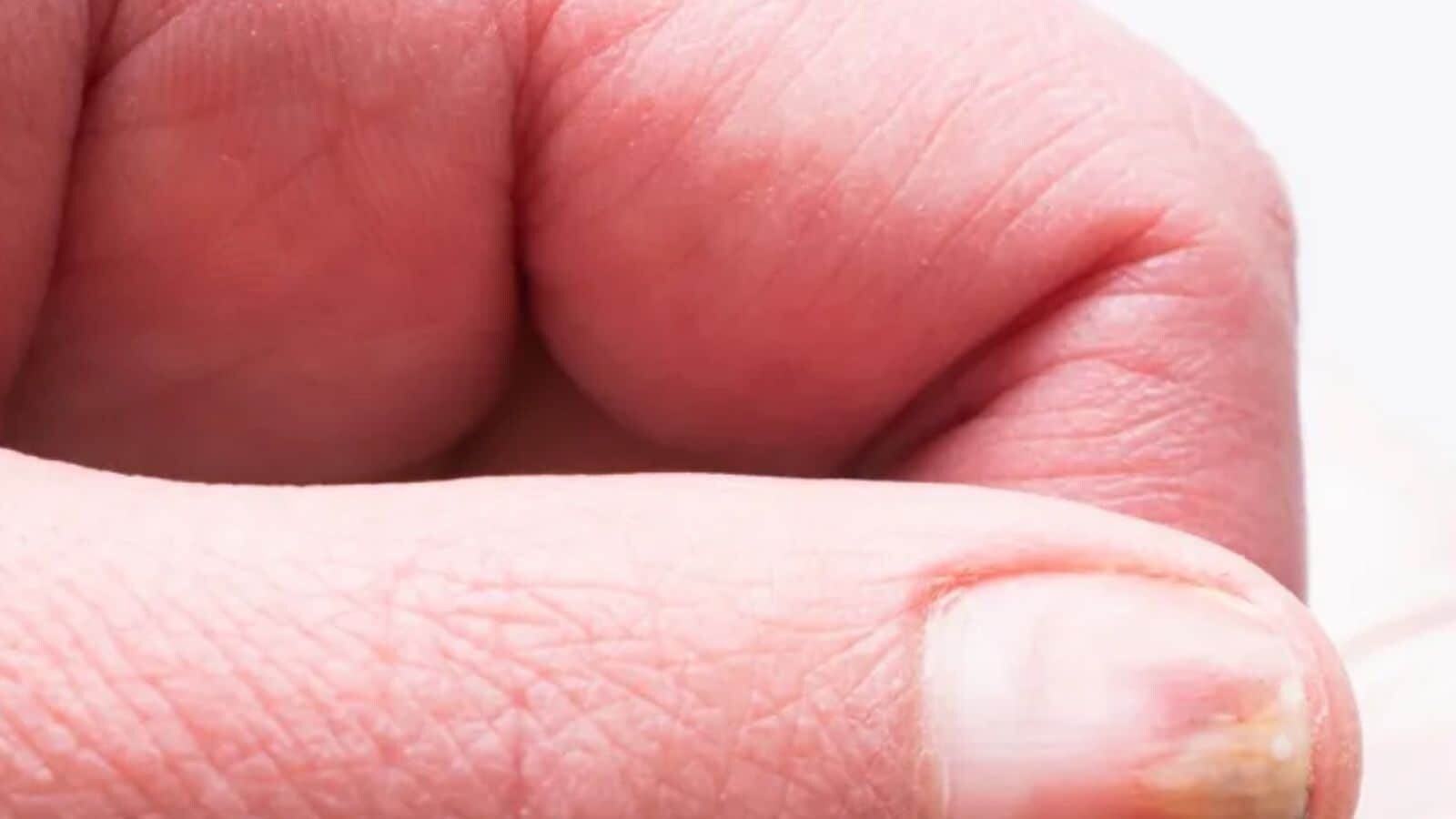 Chewing Nails Skin: గోళ్ల చుట్టూ ఉన్న చర్మాన్ని కొరికే అలవాటు ఉందా? ఈ ...