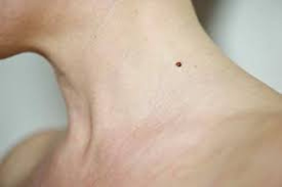 Moles on body: నడుంపై పుట్టుమచ్చ ఉందా ...