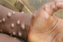 Monkeypox: మంకీపాక్స్... మరో వైరస్ వచ్చేసింది.. అమెరికాలో కలకలం.. ఇది డేంజరా?