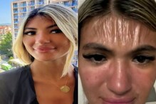Woman plastic skin : అమ్మ బాబోయ్.. 30 నిమిషాల ఎండకి మారిపోయిన మహిళ మొఖం