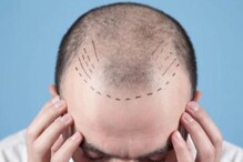 Hair Transplant Fail :  హెయిర్ ట్రాన్స్‌ప్లాంట్ విఫలమై వ్యక్తి ఆత్మహత్య