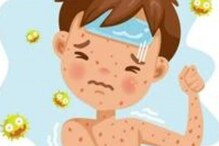 Measles: భయపెడుతున్న మీజిల్స్.. పిల్లల్లో వేగంగా వ్యాప్తి.. లక్షణాలేంటి? నివారణ మార్గాలు