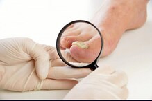 Nail Fungus : గోళ్లు పాడవుతున్నాయా.. ఫంగస్ కావచ్చు.. ఈ జాగ్రత్తలు తీసుకోండి