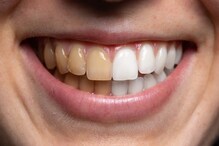 White Teeth : దంతాల గార పోయి తెల్లగా మెరవాలా?.. సింపుల్ చిట్కాలు