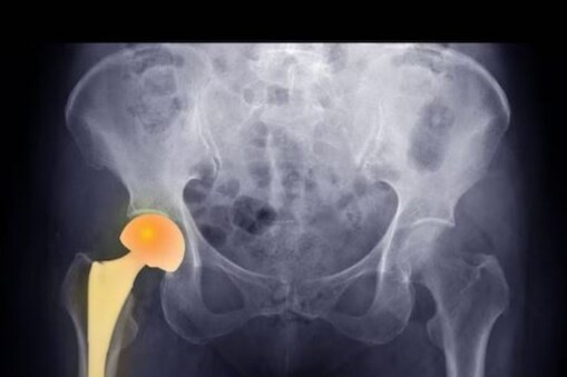 Hip Arthroplasty