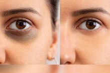 Dark circles: కళ్ల కింద నల్లటి వలయాలను పూర్తిగా పోగొట్టే సింపుల్ హోం రెమెడీస్..
