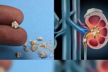 Kidney stones: కిడ్నీల్లో స్టోన్స్ రాకుండా ఉండాలంటే ఈ 5 అలవాట్లను పాటించండి..!