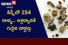 OMG: కిడ్నీలో 154 రాళ్ళు.. ఆశ్చర్యానికి గురైన డాక్టర్లు