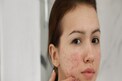 Acne: మొటిమలకు, అవయవాల ఆరోగ్యానికి సంబంధం.. ఏ ప్లేస్‌లో మొటిమలు దేనికి సంకేతం?