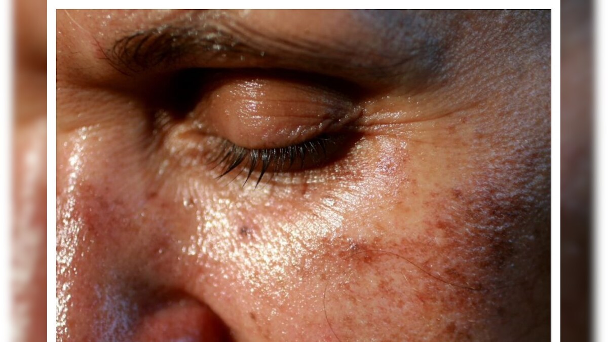 మీరు పిగ్మెంటేషన్ వల్ల ఇబ్బంది పడుతున్నారా? ఈ 5 సింపుల్ రెమెడీస్ మీకోసం..