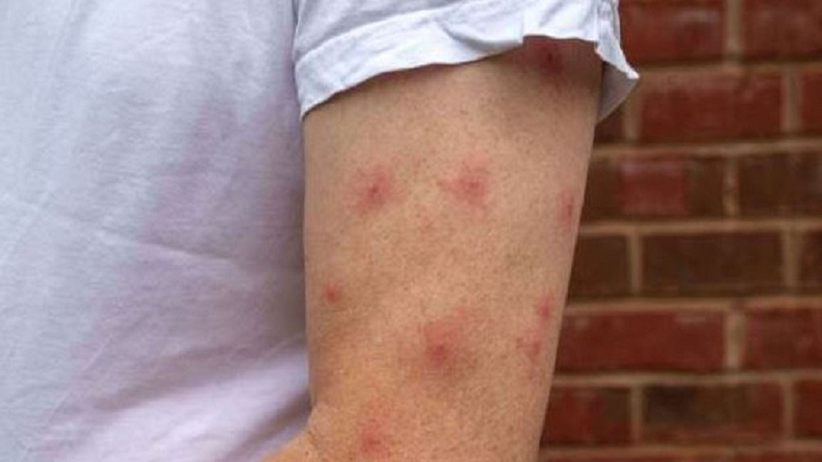 Peru Insect Bite Relief From Insect Bite: వర్షాకాలంలో పురుగు కరిచిందా ? ఈ 5 చిట్కాలు ...