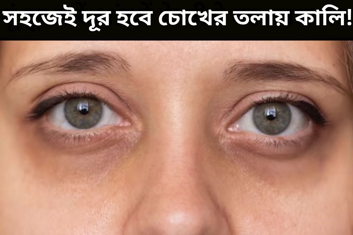 Dark Circle కళ్ల కింద నల్లటి వలయాలు ఉన్నాయా.. ఇంట్లోనే ఈ టిప్స్