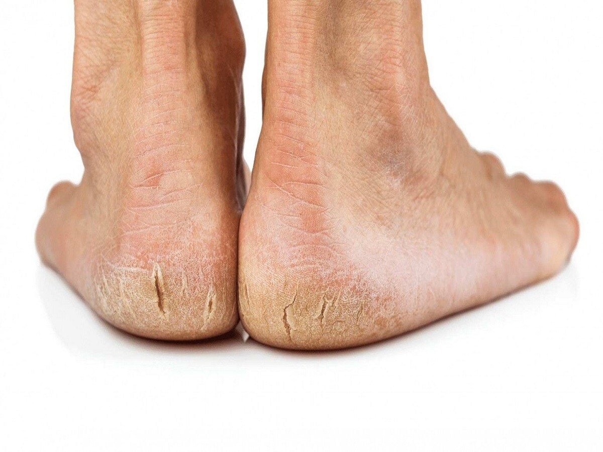 Understanding Diabetic Foot Problems: Causes and Solutions for Dry, Cr -  SkinIntegra