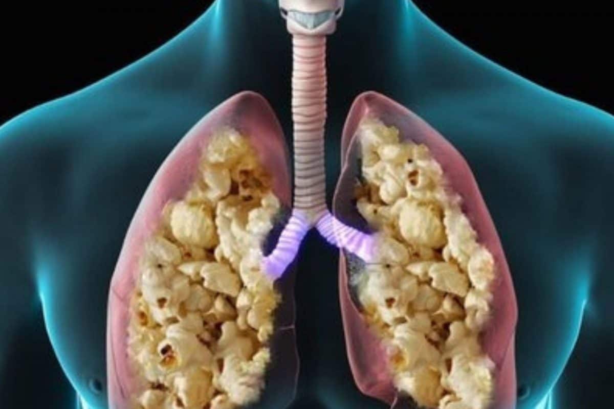 Popcorn Infection Popcorn Lung Signs: కఫం లేకుండా దగ్గు వస్తోందా? ఈ వ్యాధికి సంకేతం..!