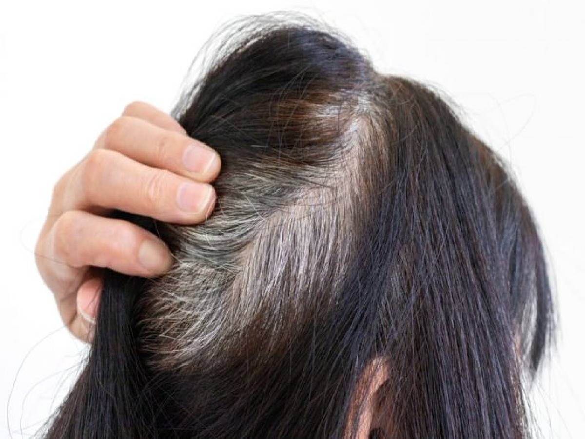 Vitamin Deficiency, grey hair, grey hair problem Vitamin Deficiency