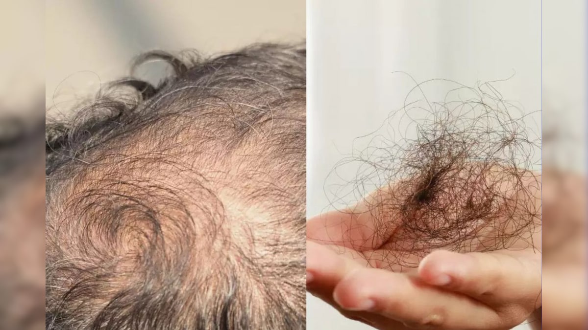Hair fall: మీ జుట్టు రాలిపోతుందా? అయితే దీనికి ప్రధాన కారణాలు ఇవే..