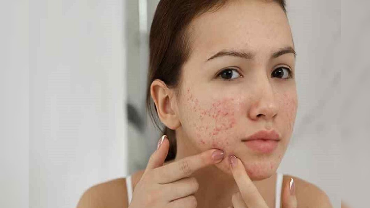 Health tips : ఈ ఆకురసాన్ని మొటిమలపై రాస్తే రెండో రోజుల్లో మాయం.. ముడతలు కూడా