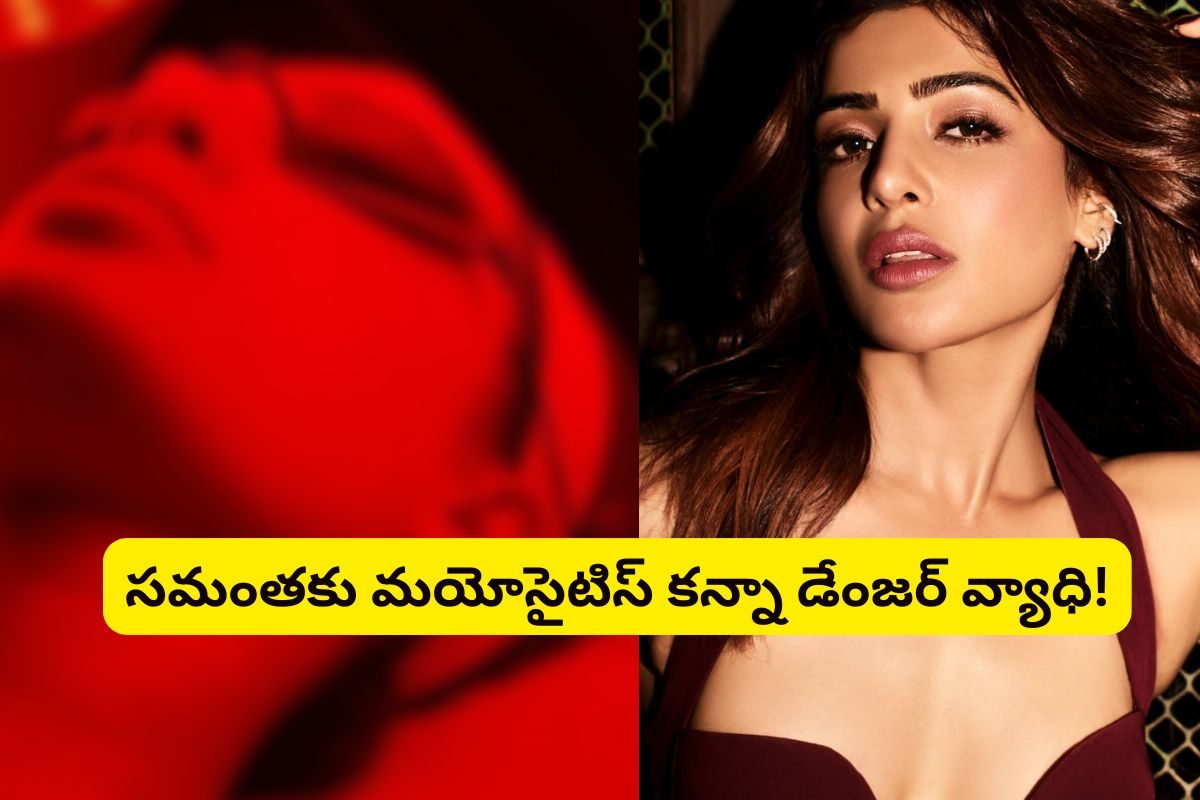Samantha: సమంతకు మరో అరుదైన వ్యాధి.. మయోసైటిస్ కన్నా డేంజర్.. ఫ్యాన్స్‌కు షాక్!
