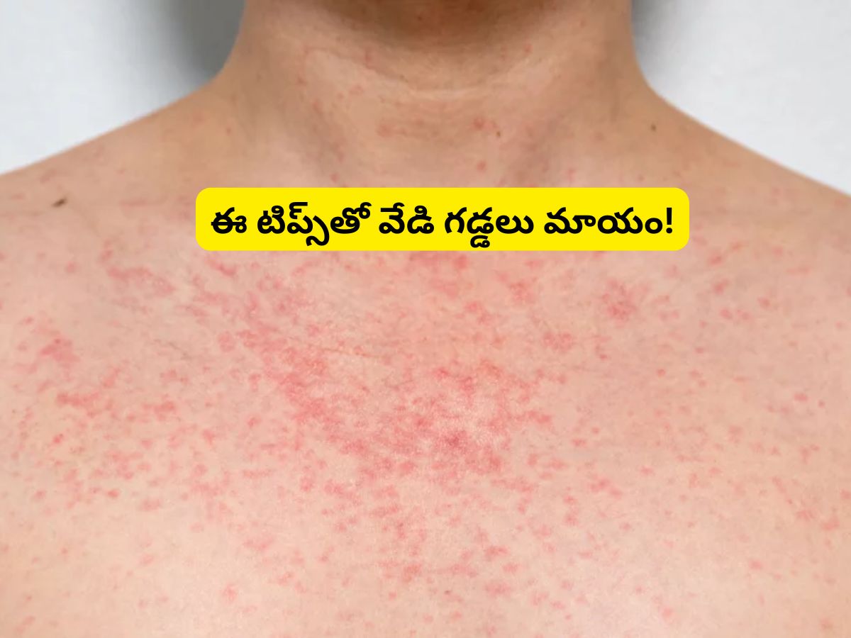 Summer Heat Rash: చెమట గడ్డలు, రాషెస్‌తో బాధపడుతున్నారా?.. పైసా కూడా ...