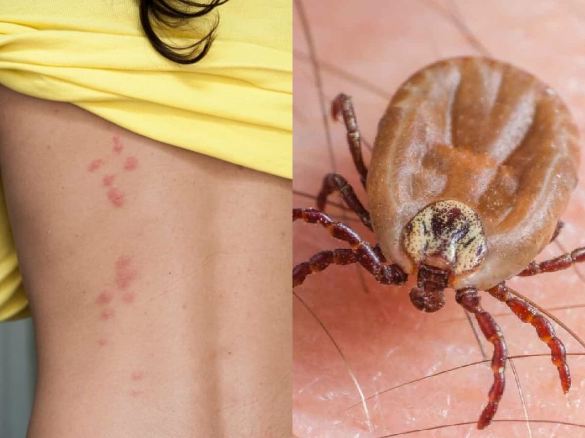Insects Incheeks Insects: మన శరీరంపై జీవించే 9 కీటకాలు చాలా డేంజర్.. కంటికి కనిపించవు ...