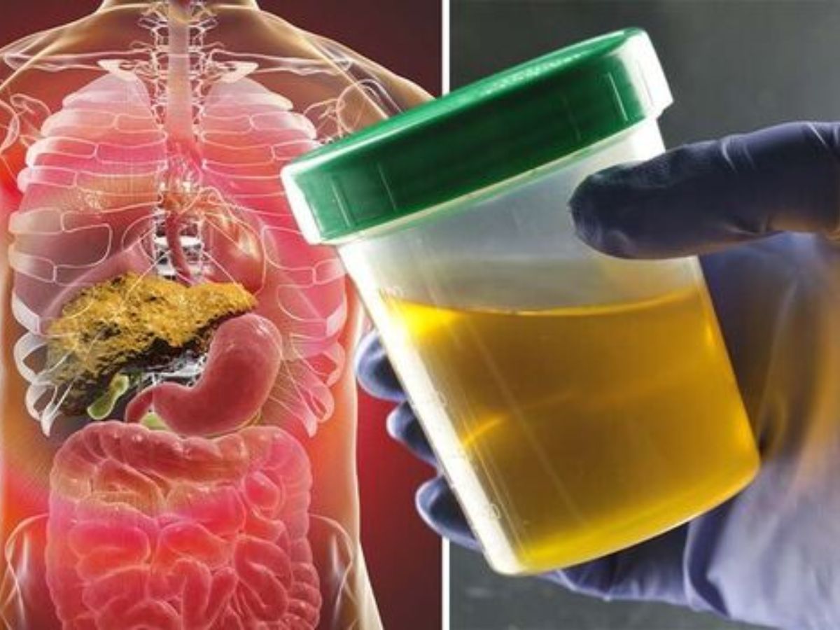 Liver Failure Color Liver Damage: మీ మూత్రం రంగులో ఈ మార్పు ఉంటే లివర్ డ్యామేజ్ అయినట్టే ...