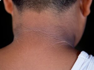 गर्दन का कालापन सिर्फ गंदगी नहीं! जानें स्वास्थ्य कारण और घरेलू उपाय.