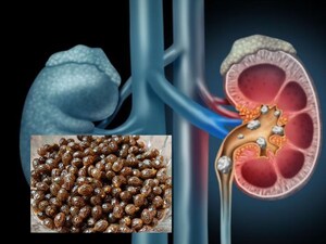 Kidney Stones Recur After Surgery? Shocking Truth Revealed!