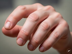 Chilblains: Why Fingers Swell in Winter & How to Prevent It
