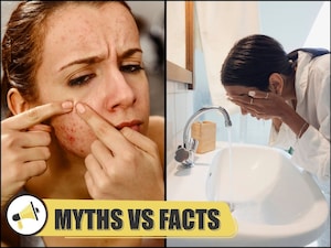 Myth vs. Fact: Frequent Face Washing Harms Skin, Causes Pimples
