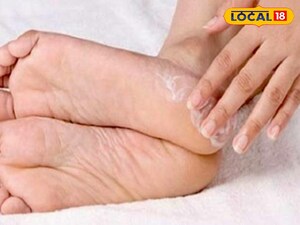 Winter Cracked Heels? Expert Tips for Smooth, Pain-Free Feet!