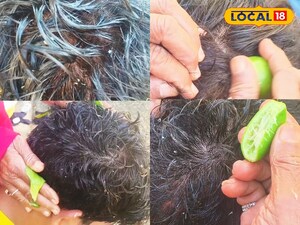 Rs. 5 Dandruff Cure: Lemon & Aloe Vera Remedy Removes Root Dandruff Naturally