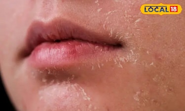 Winter Skin Woes? Banish Dry, Cracking Skin with These Expert Tips!