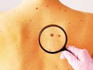 कैंसर के इन लक्षणों को नज़रअंदाज़ न करें: शुरुआती पहचान बचा सकती है जान!