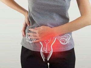 PCOD: बिना दवाओं के पॉलीसिस्टिक ओवरी सिंड्रोम को प्राकृतिक रूप से नियंत्रित करें!