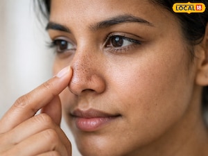 सर्दियों में ब्लैकहेड्स से परेशान? अपनाएं ये प्राकृतिक उपाय.