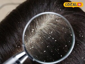 घर पर ही डैंड्रफ से पाएं छुटकारा: स्वस्थ स्कैल्प के लिए आसान आयुर्वेदिक उपाय.