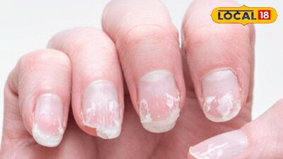 नाखूनों का स्वास्थ्य: क्या आपके नाखून बताते हैं किडनी की समस्या? तुरंत जांचें ये संकेत.