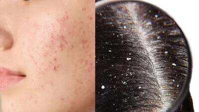 Aloe Vera: The Natural Solution for Dandruff, Pimples & More!