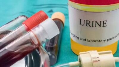 Urine Alert: Color, Odor Changes Signal Serious Health Issues. Don't Ignore!