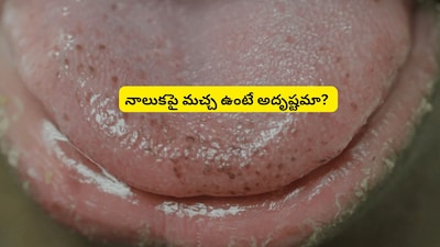 Mole on Tongue: Fact or Fiction? Unpacking Ancient Beliefs and Modern Views